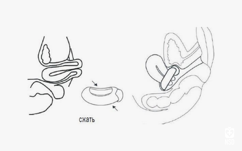 Silicone Pessary Bowl-Shaped - Urethral