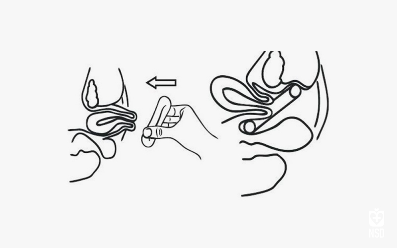 Silicone Pessary Ring