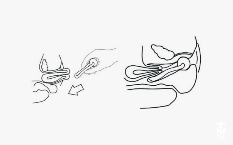 پساری Urethral